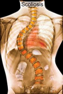 Image of a spine with scoliosis