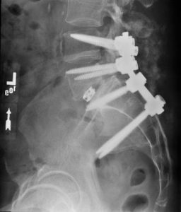 Spondylolisthesis corrected using special rods, screws, and spacers.