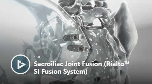 Sacroiliac Joint Fusion (Rialto™ SI Fusion System) thumbnail