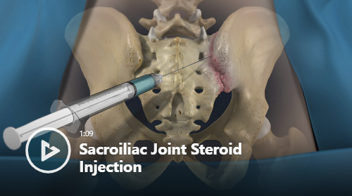 Sacroiliac Joint Steroid Injection thumbnail