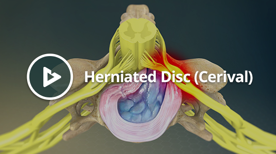 Herniated Disk (Cervical) Thumbnail