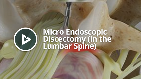 Micro Endoscopic Discectomy thumbnail