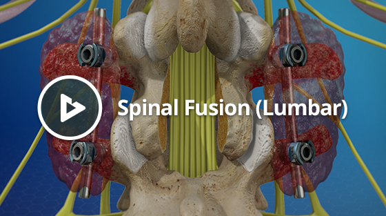 SPINAL FUSION FOR SPONDY Thumbnail