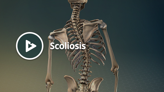 Scoliosis Thumbnail